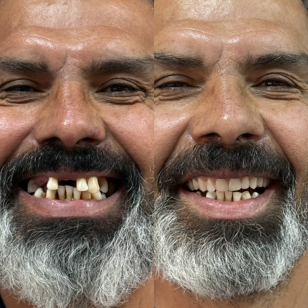 Paciente da Ennova com os dentes reabilitados por implantes