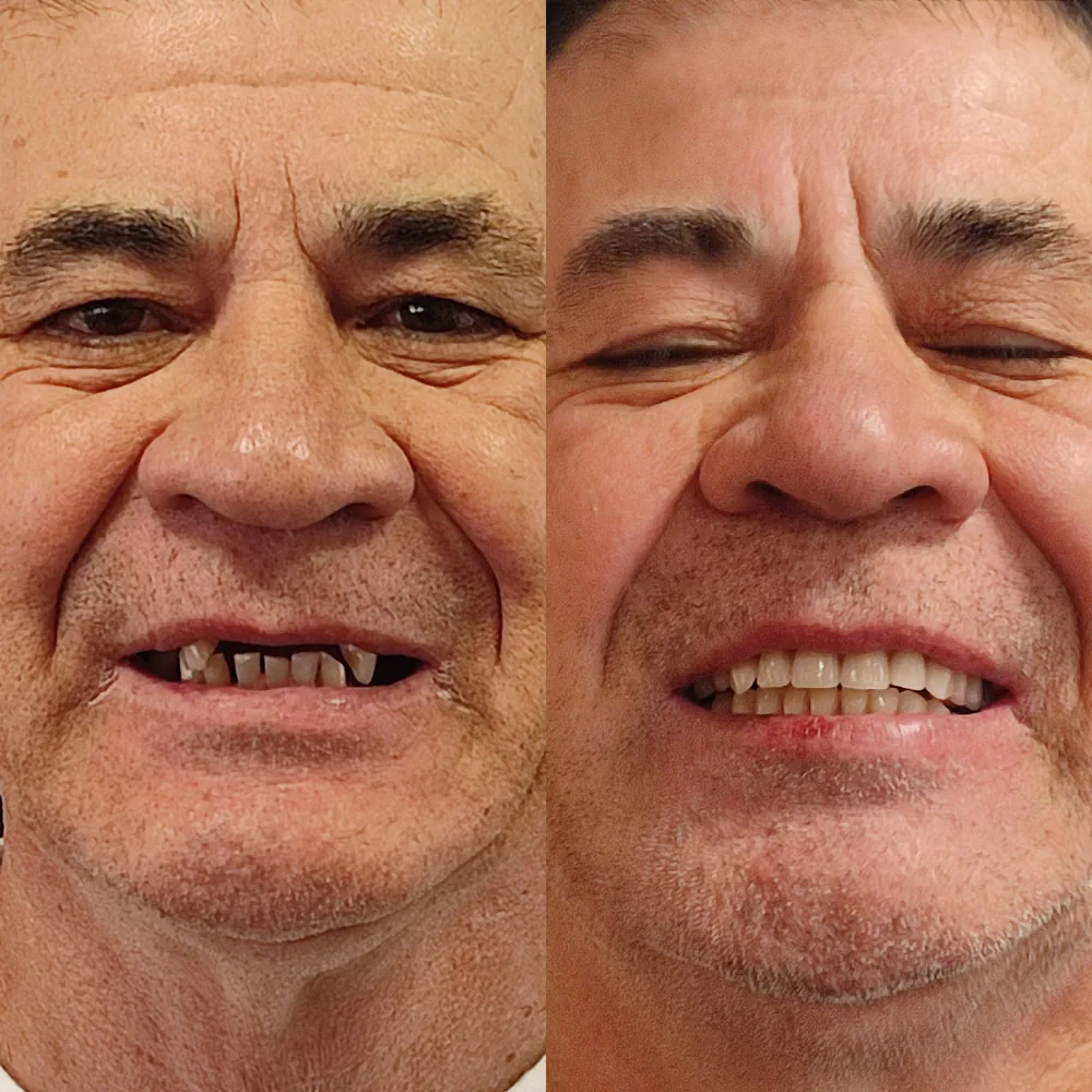 Paciente da Ennova que recuperou a mastigação com dentes fixos