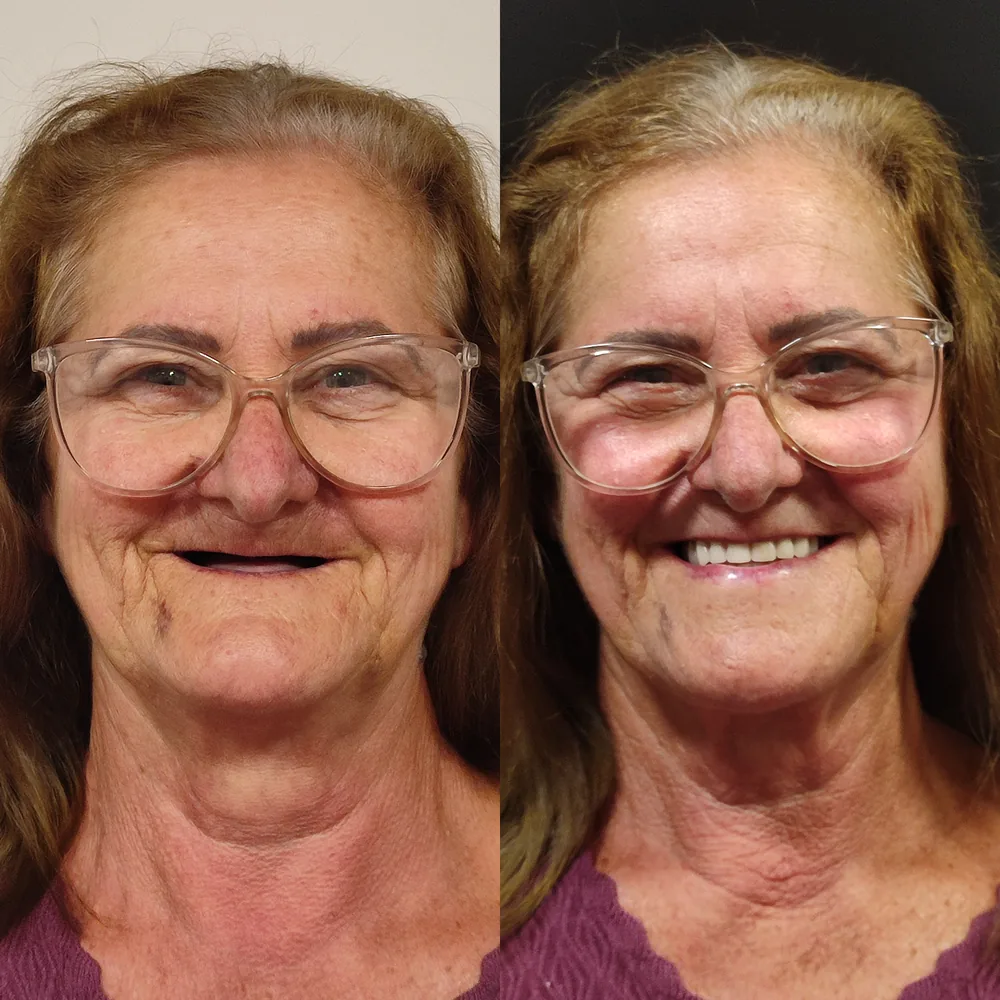 Paciente da Ennova que trocou a dentadura por dentes fixos
