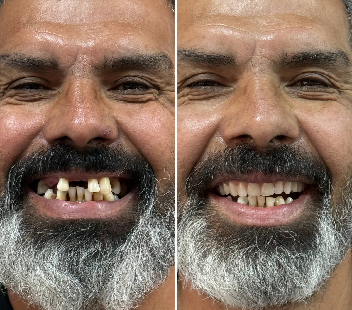 Paciente da Ennova Odontologia antes e depois da reabilitação com implantes